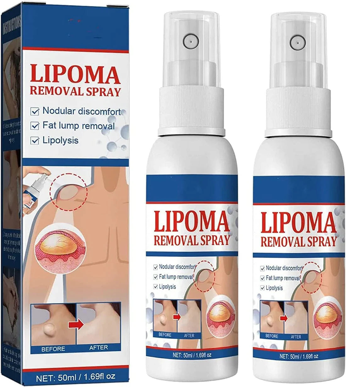 LAST DAY OF DISCOUNT  🔥  LIPOMA REMOVAL SPRAY