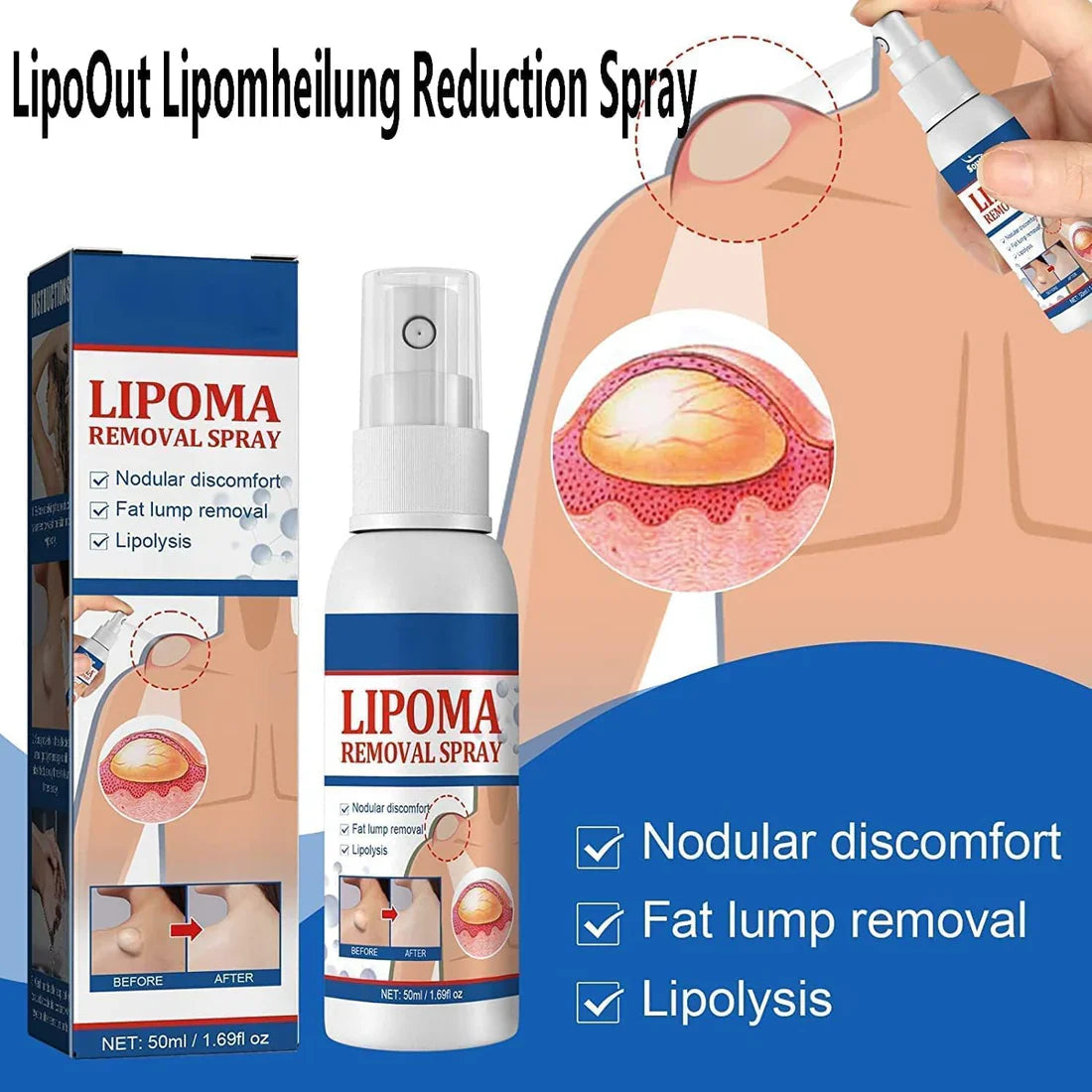 LAST DAY OF DISCOUNT  🔥  LIPOMA REMOVAL SPRAY